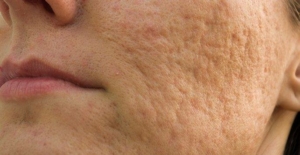 Bellafill Acne Scars Baltimore Washington DC