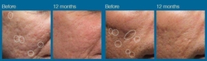 Acne Scar Baltimore Washington DC