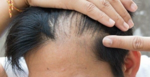 hair restoration