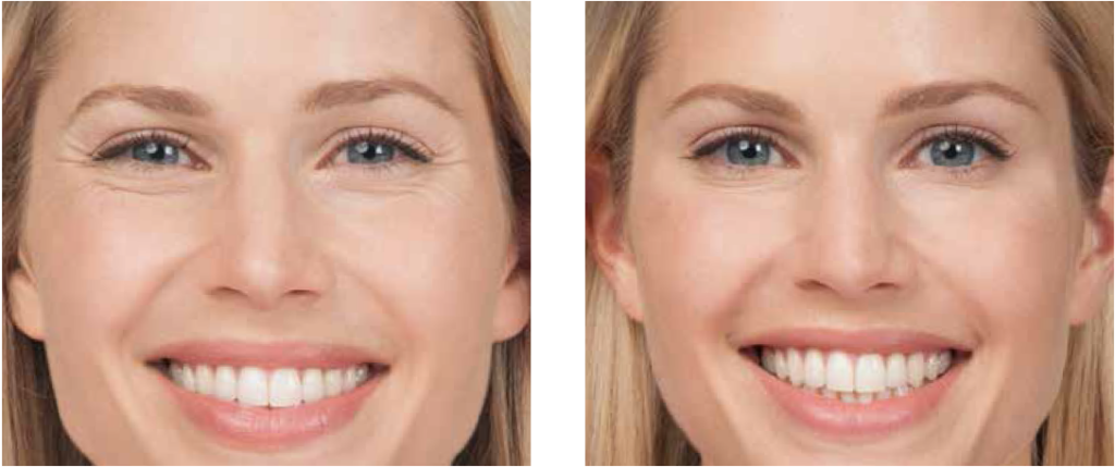 How Long Does Botox Take To Work? | Promd Health | Botox