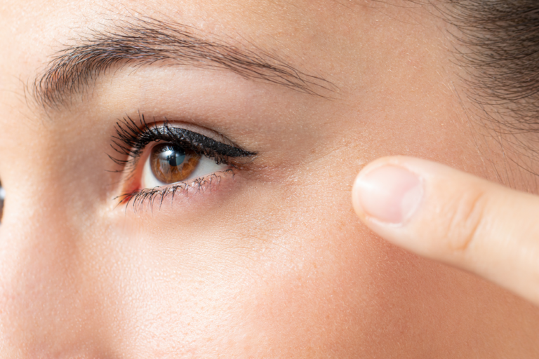 Best Filler for Crows Feet? 10 Reasons to Consider Dysport Injections