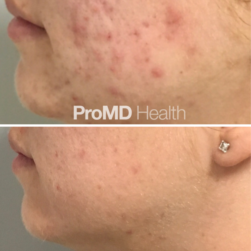 Acne Treatments