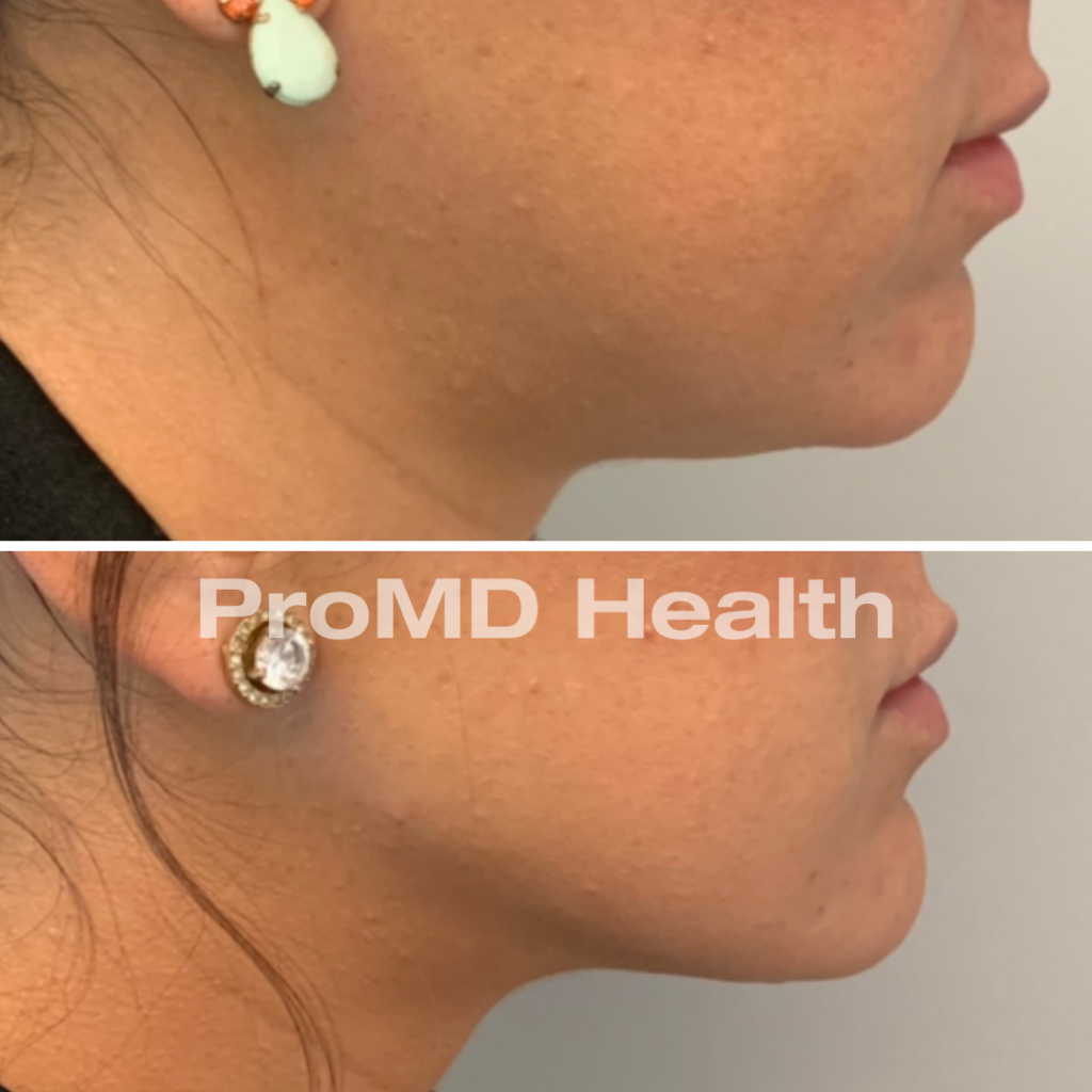 Jawline Filler