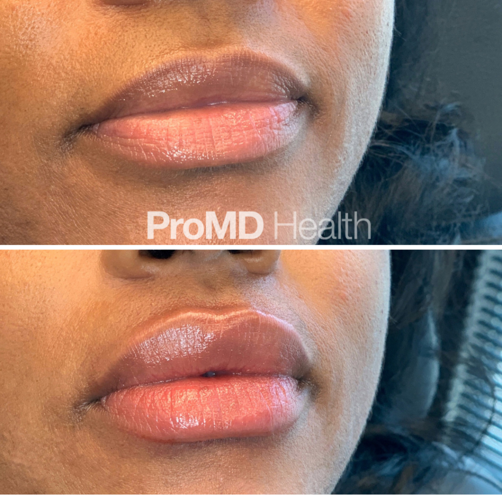 Lip Filler