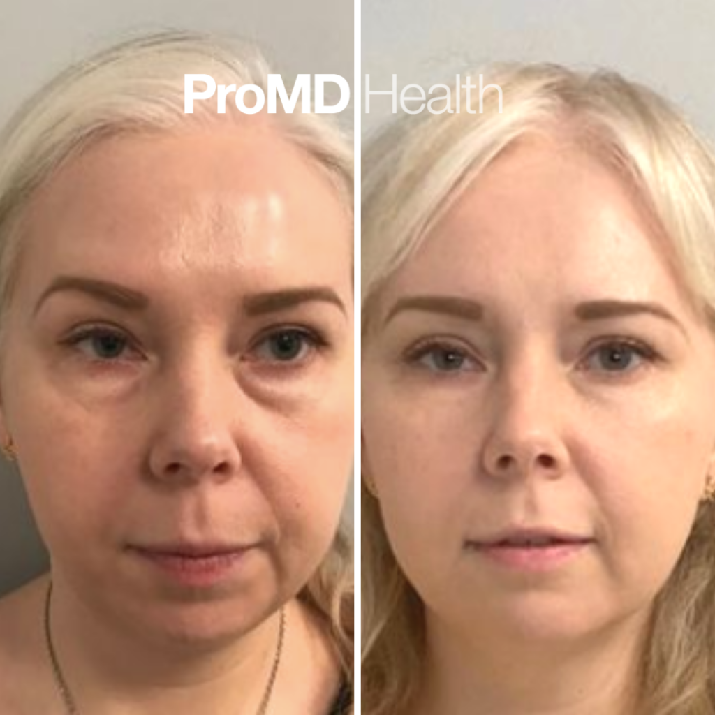 Midface Filler