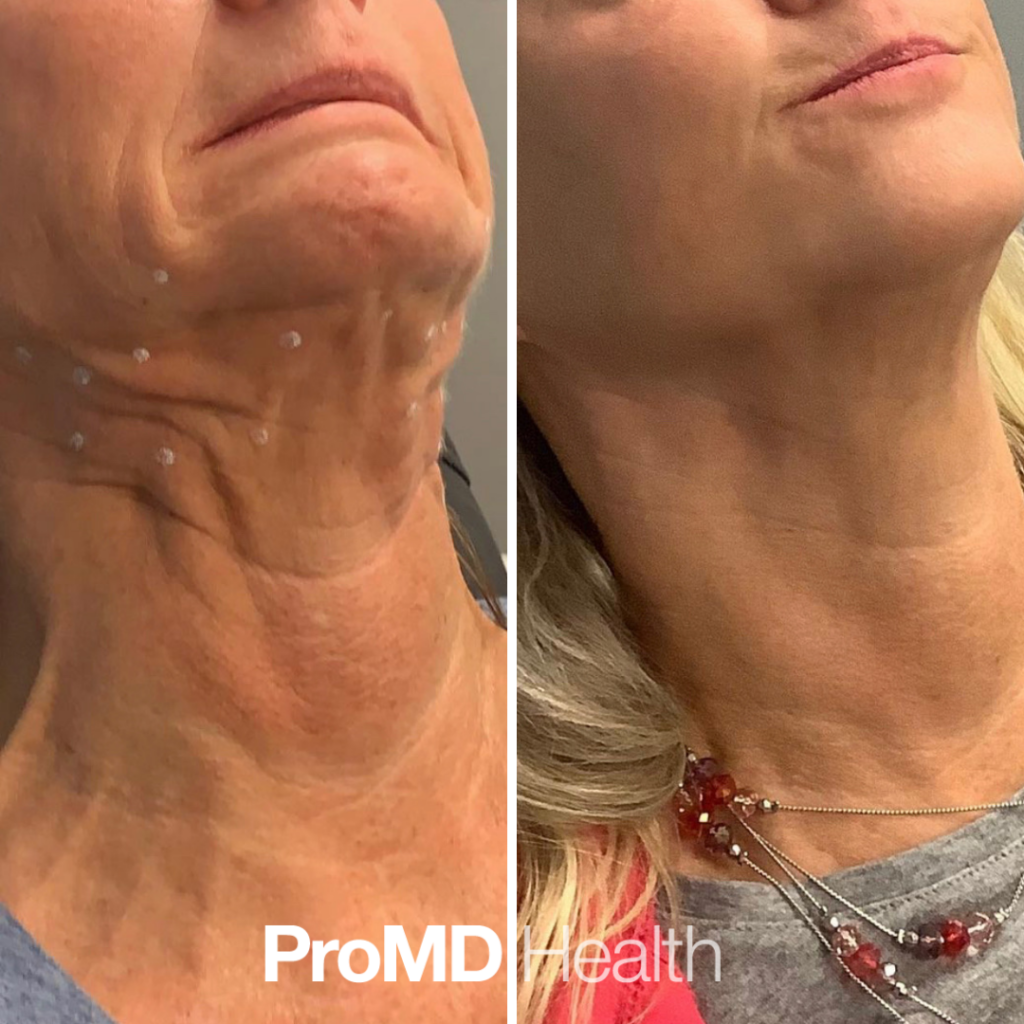 Neck Rejuvenation