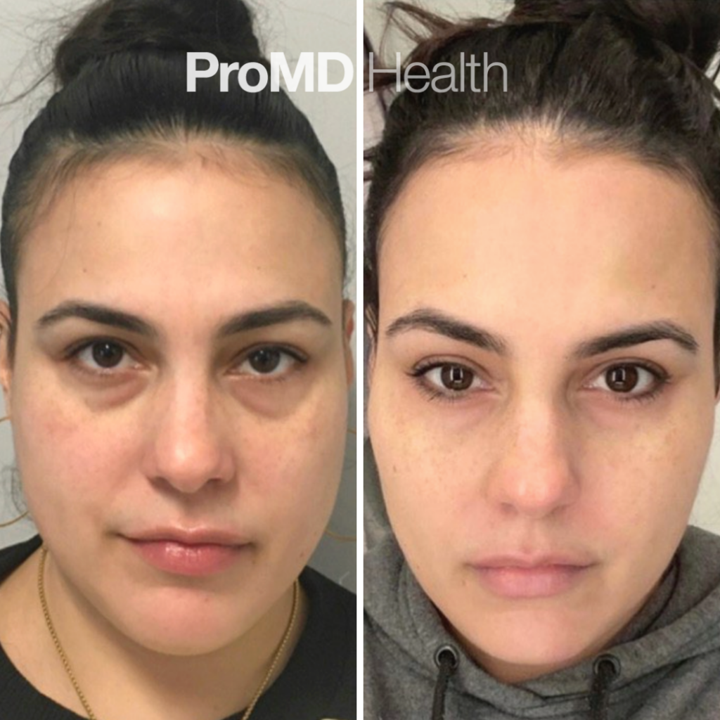Under Eye_Cheek Filler