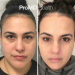 Under Eye_Cheek Filler