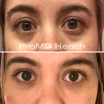 Panfacial