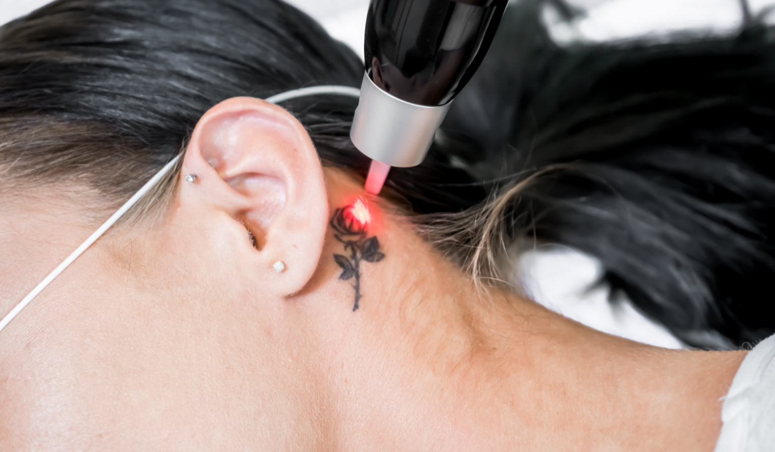 Tattoo Removal 2 at ProMD Health Desktop