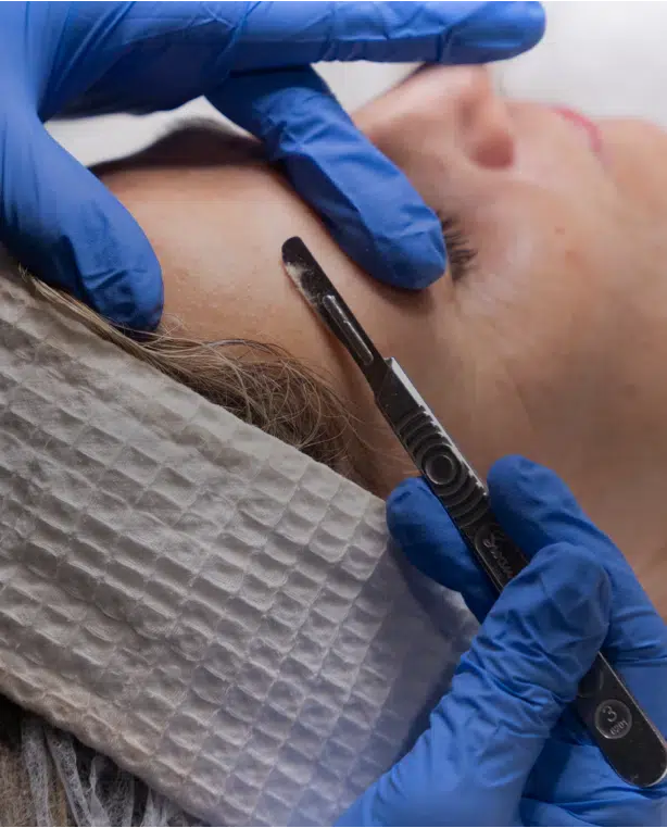 Dermaplaning