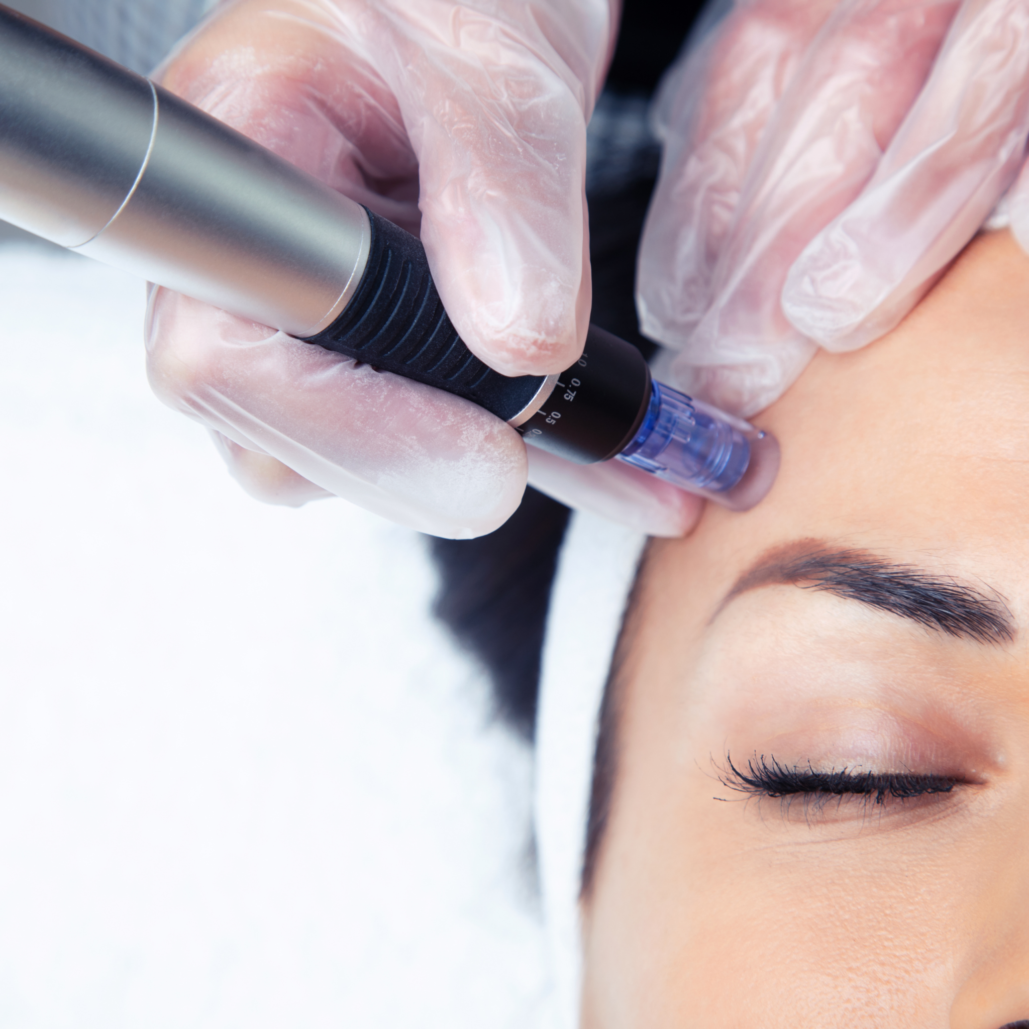Microneedling