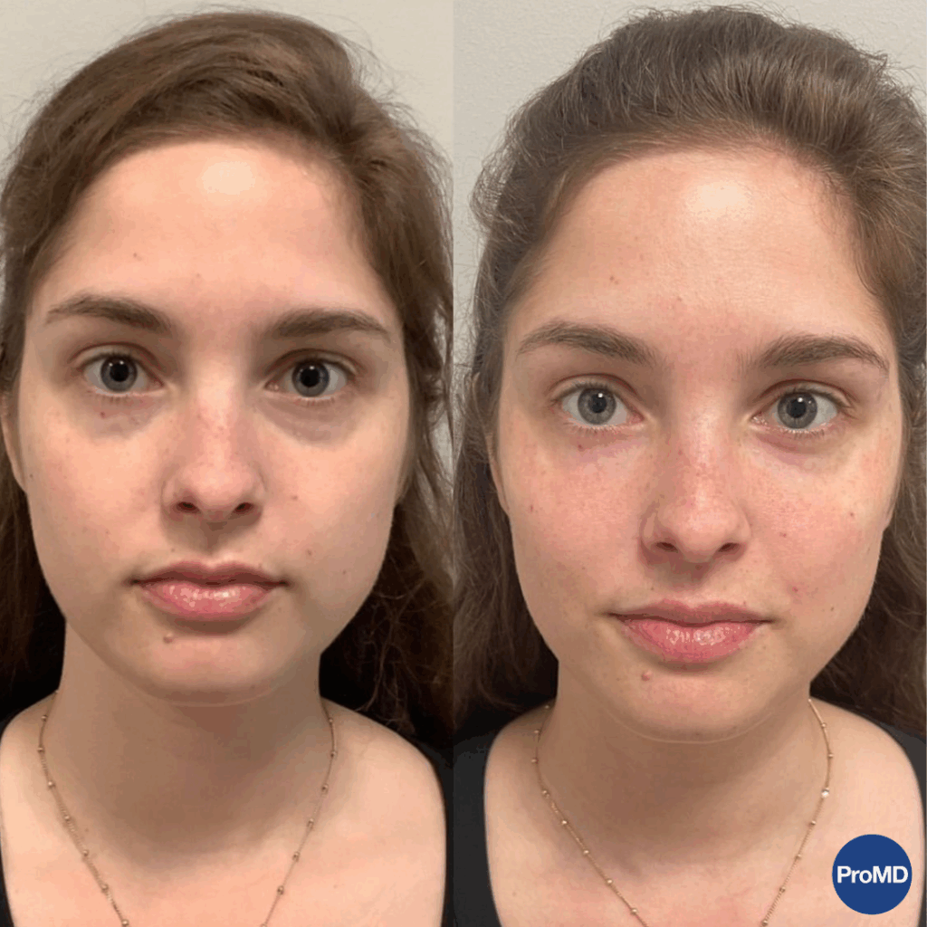 ProMD Annapolis Max Before and After Botox