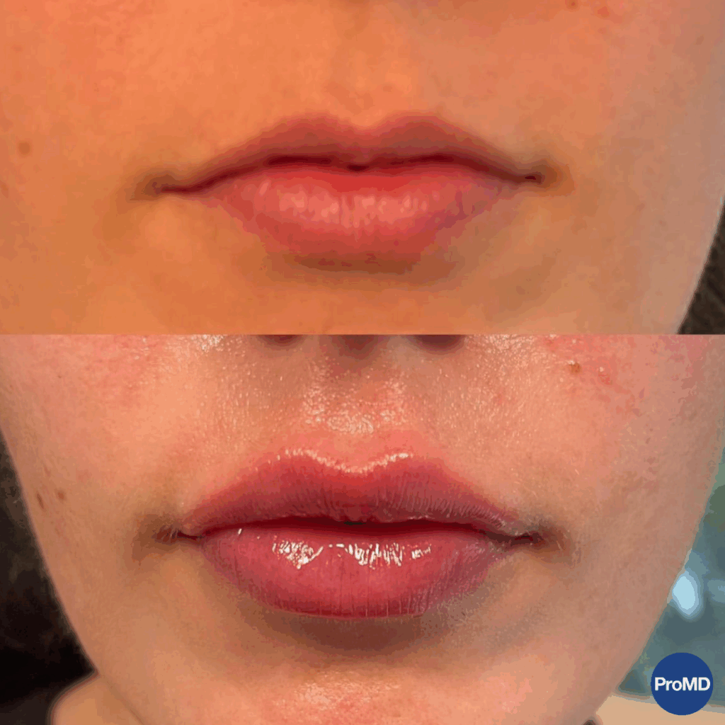 ProMD Annapolis Max Before& After Lips