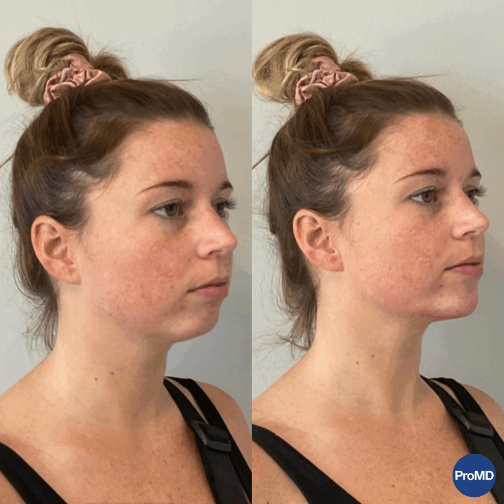ProMD Annapolis Max Before& After Chin Filler