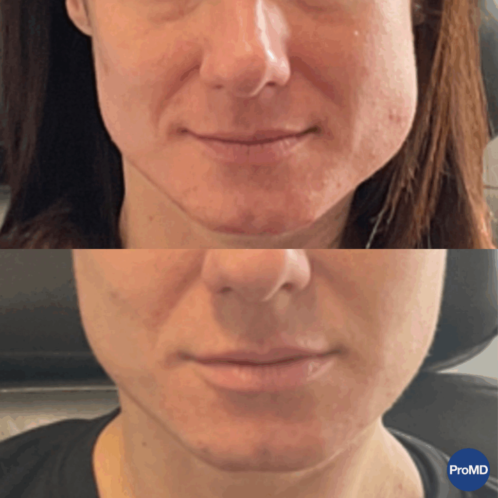 ProMD Annapolis Max Before& After Massetter