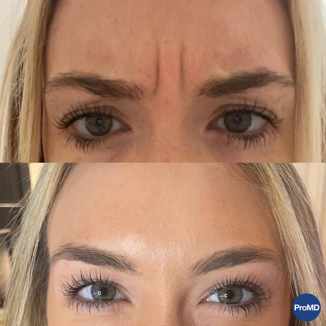 Real patient Botox results — ProMD Health Bel Air