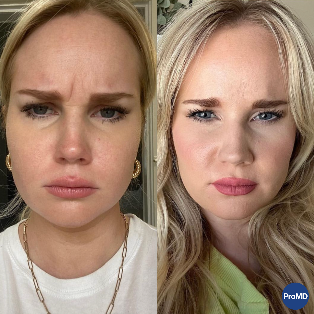 Real patient Botox results — ProMD Health Bel Air