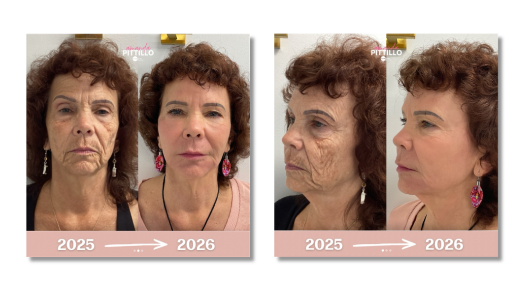 ProMD Health Bel Air personalized facial rejuvenation and wellness planning before and after