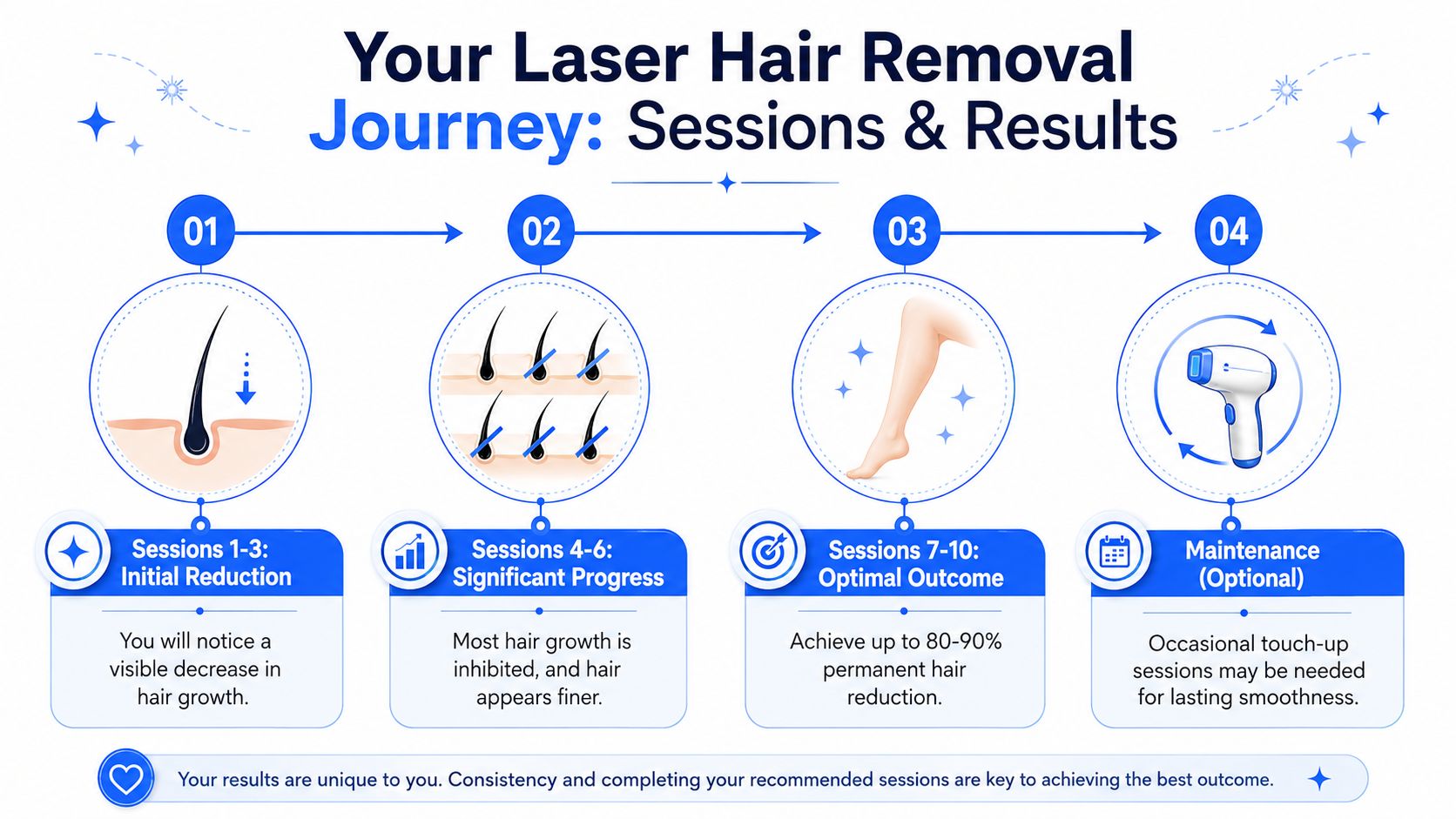 A visual infographic explaining the four stages of laser hair removal, from initial reduction to maintenance.