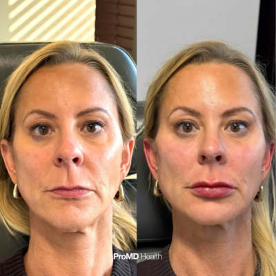 Full facial balancing patient at ProMD Health