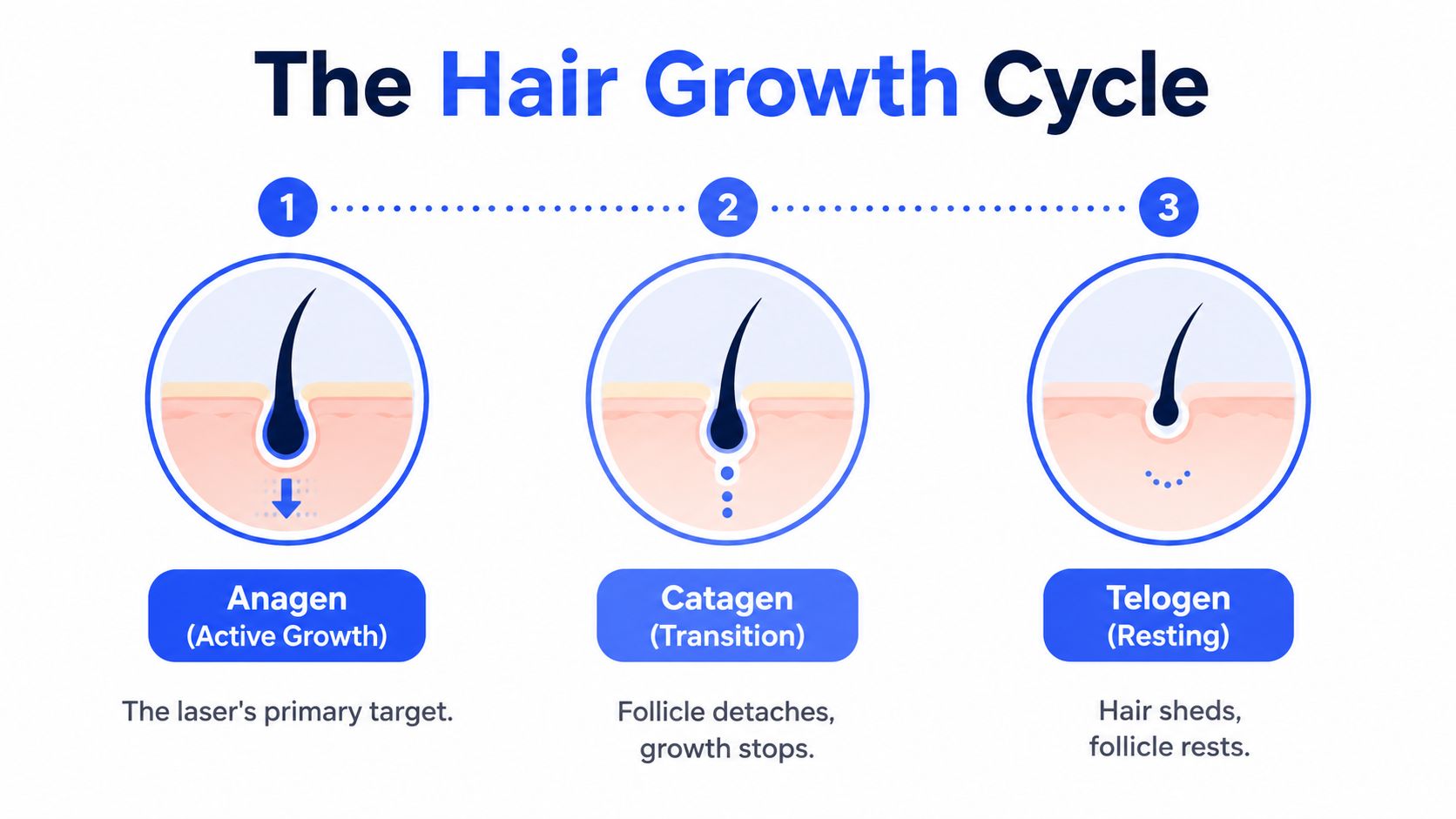 A diagram illustrating the three phases of the hair growth cycle: Anagen, Catagen, and Telogen for laser treatment.