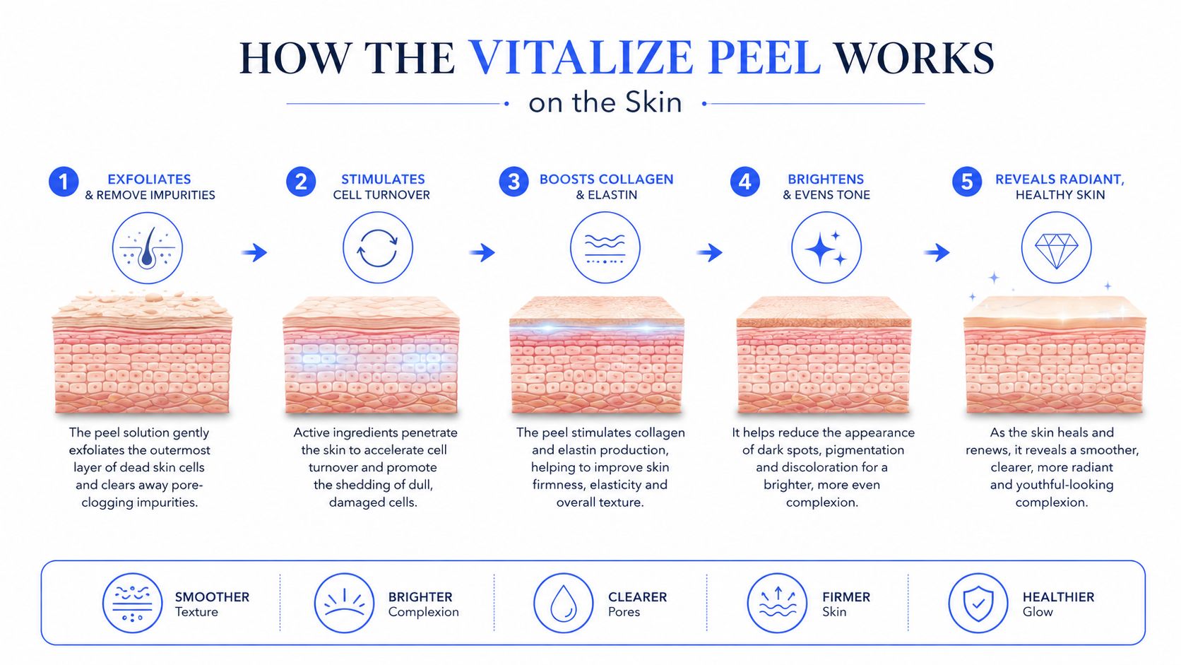 A diagram illustrating the five-step process of a Vitalize chemical peel on human skin layers.
