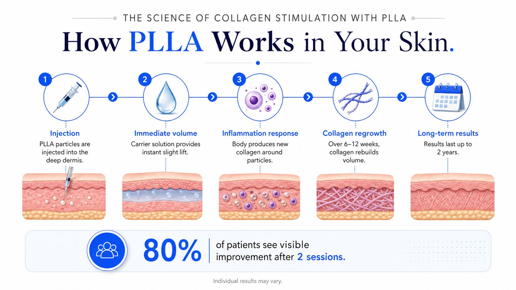 A diagram illustrating the five stages of how PLLA filler works to stimulate collagen in the skin.