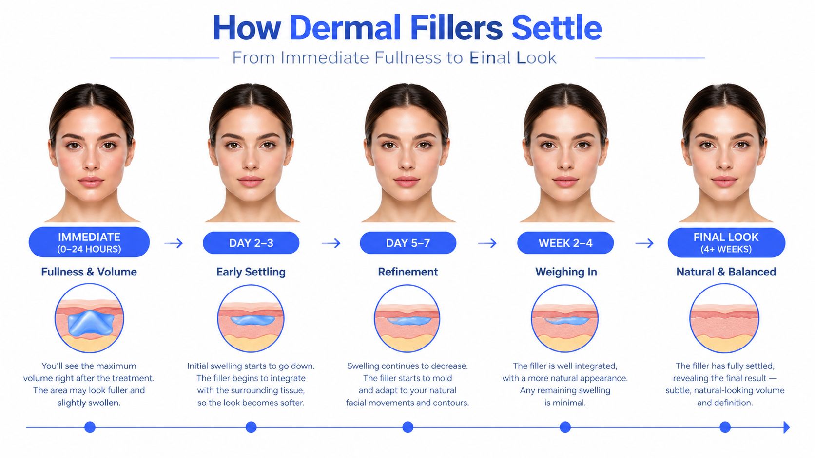A timeline graphic illustrating the stages of dermal filler settling from initial treatment to the final look.