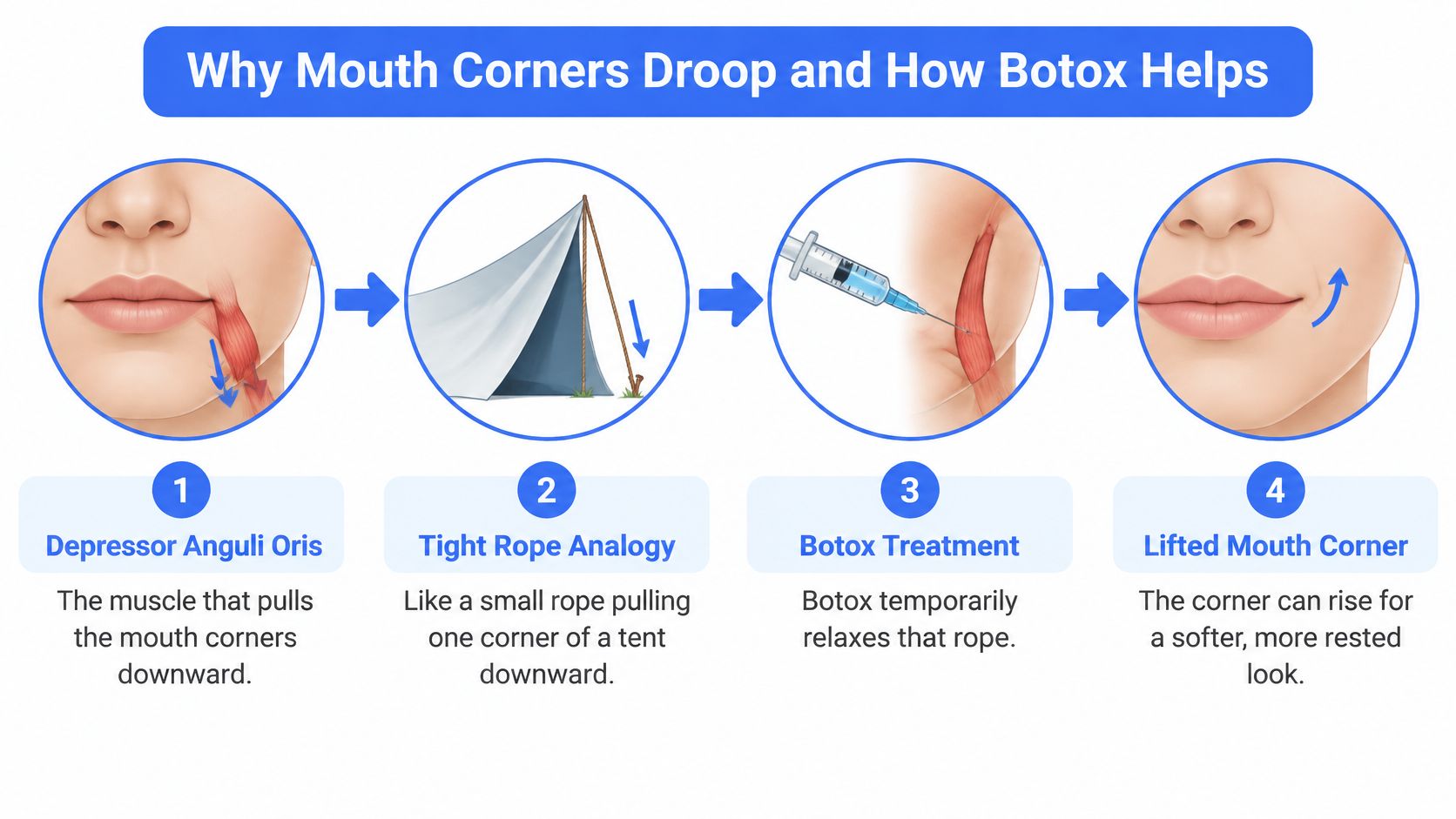 An infographic showing how Botox relaxes the depressor anguli oris muscle to lift drooping mouth corners.