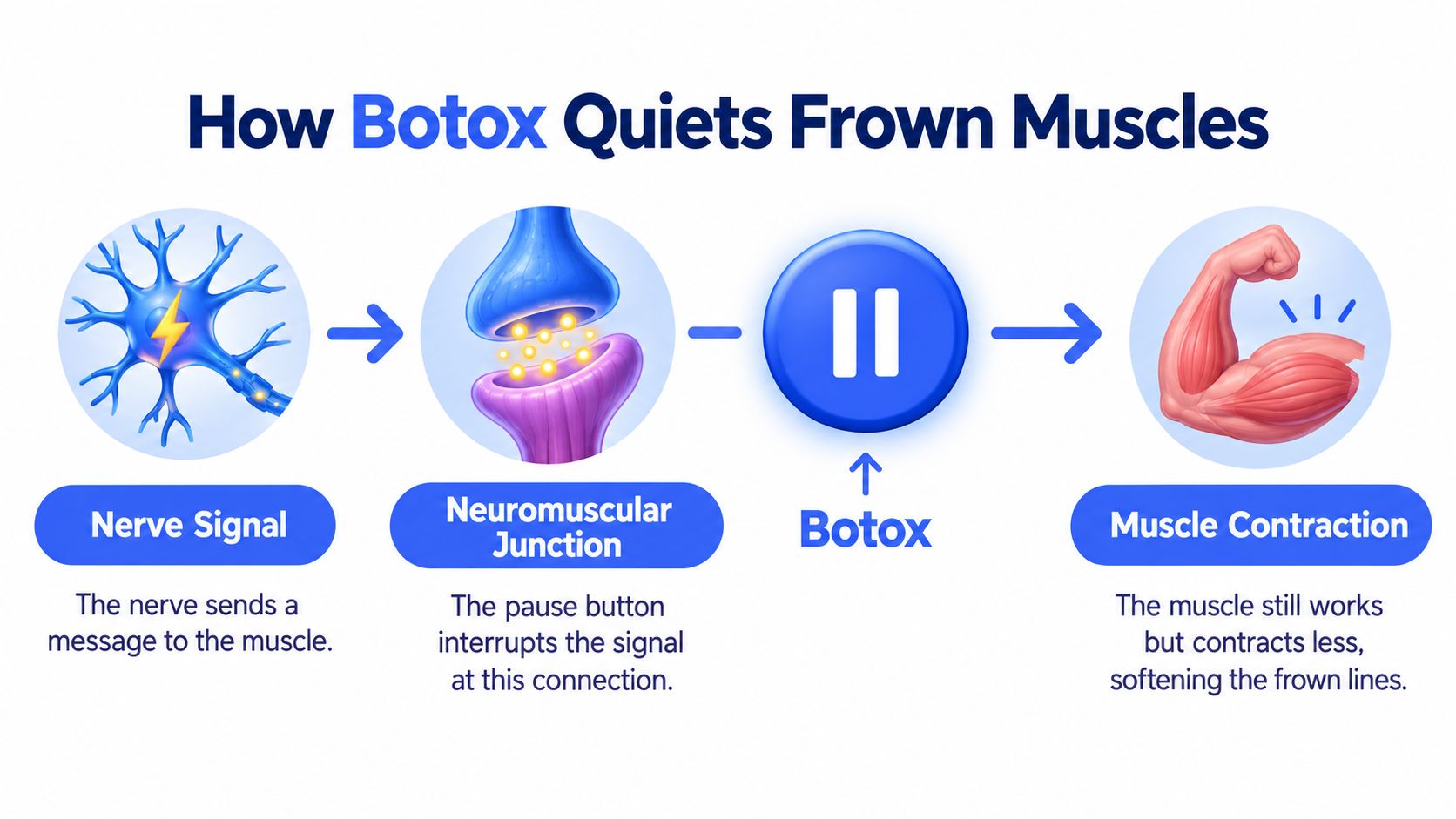A diagram illustrating how Botox stops nerve signals to muscles, reducing contractions and softening frown lines.