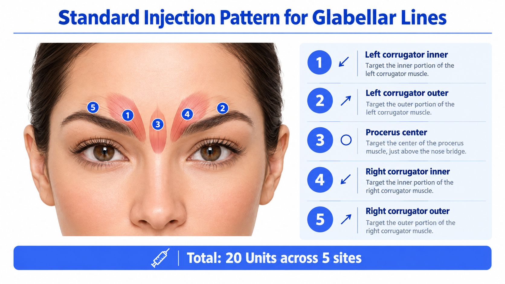 A diagram illustrating the standard five-point injection pattern for Botox treatment of glabellar frown lines between eyebrows.