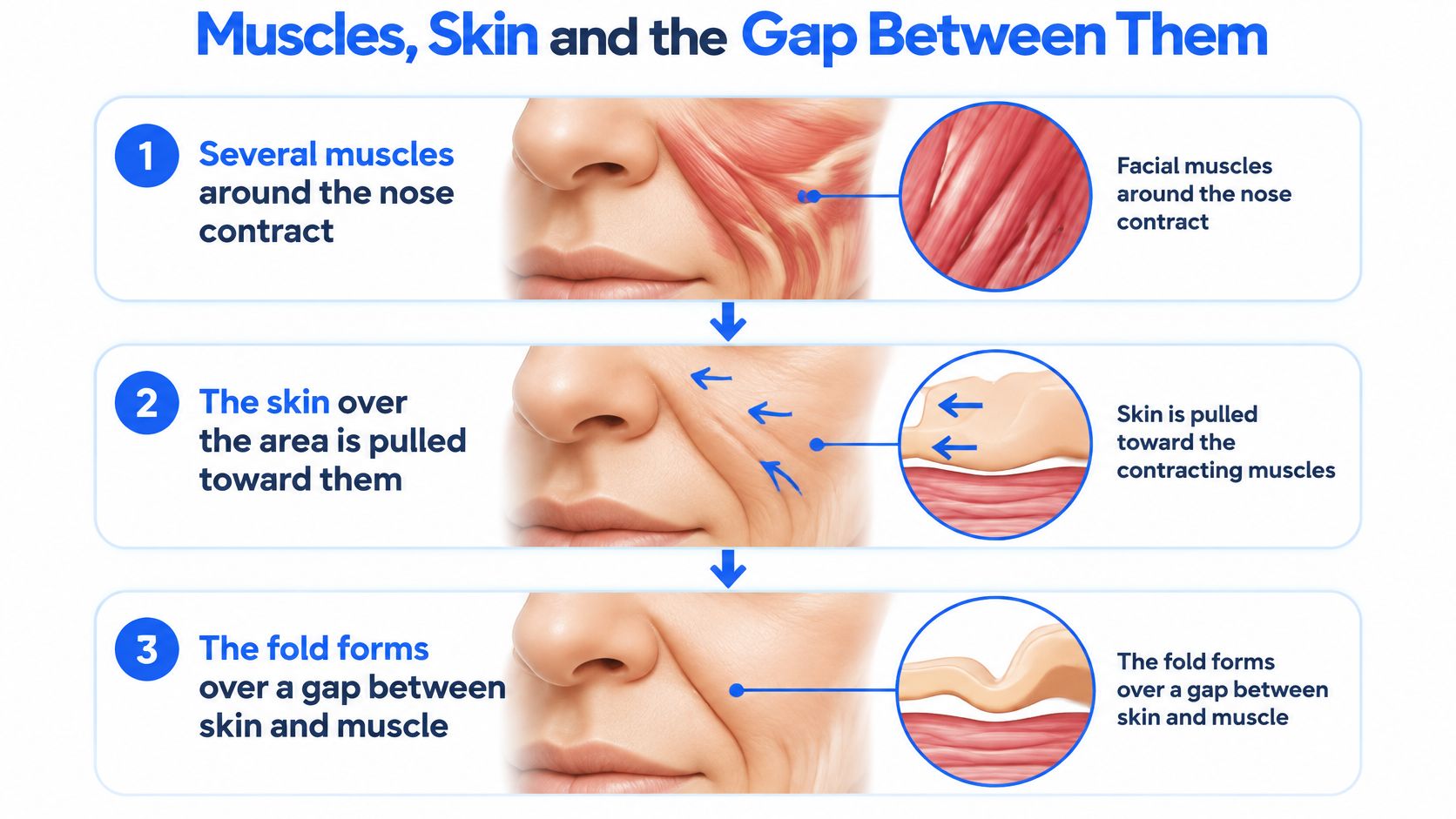An infographic illustrating how facial muscle contraction creates bunny lines or folds between skin and muscle.